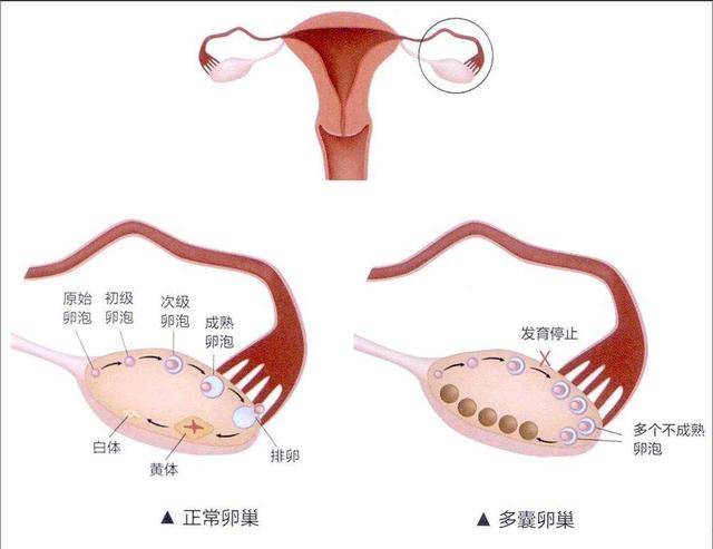 多囊卵巢综合征