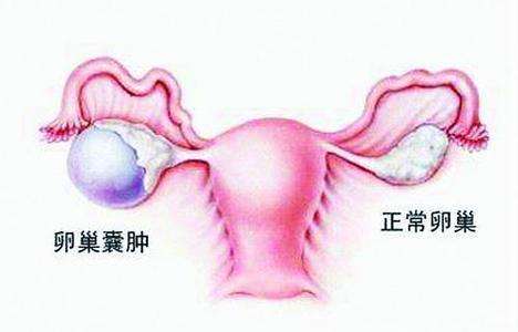 卵巢囊肿会引起卵巢衰退吗？(图1)