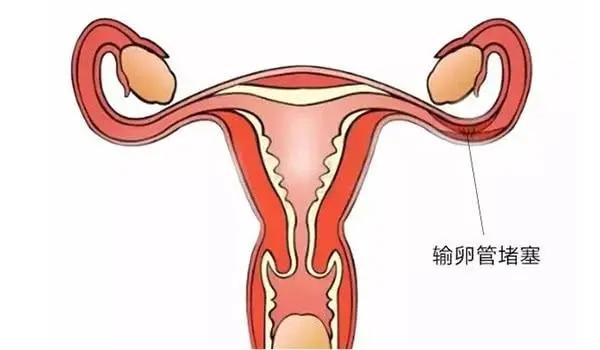 你了解输卵管阻塞吗？原因/症状/影响(图1)