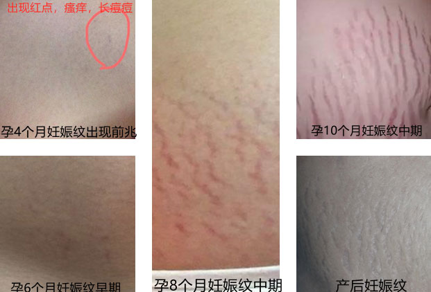 开始长妊娠纹的先兆图-专家揭秘妊娠纹的预防和(图1)