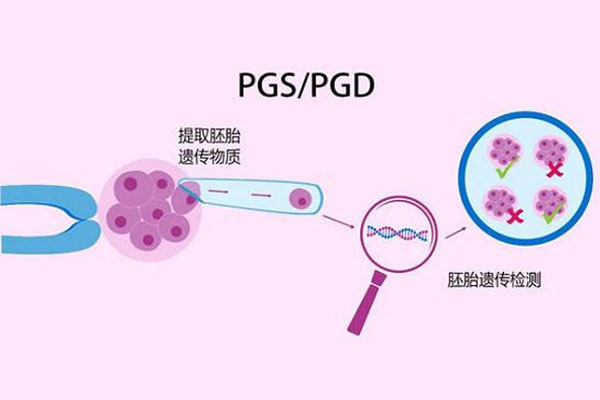 一代、二代、三代试管婴儿有什么区别