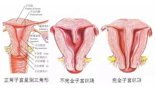 纵隔子宫有2种不同类型