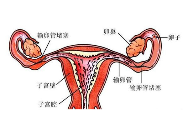 如何提前做好输卵管堵塞防范