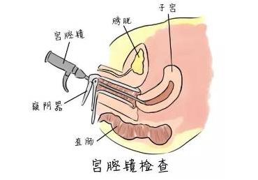 微创消灭子宫肌瘤，宫腔镜手术保护“生命之源”！(图1)