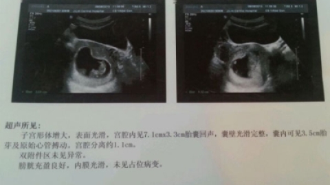 宫腔分离是什么？宫腔分离是什么原因?宫腔分离