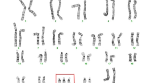13号染色体异常危害大，易导致胎儿畸形