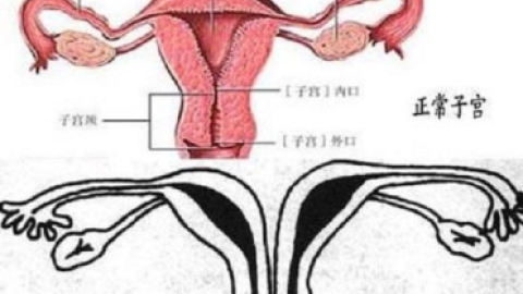 带你了解什么是纵膈子宫，别再和双子宫搞混了