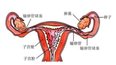 输卵管堵塞导致不孕与宫外孕及如何提前做好输