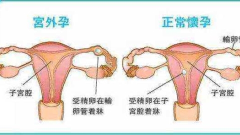 试管婴儿出现"宫外孕"，三胞胎变为双胞胎