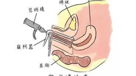 微创消灭子宫肌瘤，宫腔镜手术保护“生命之源”！