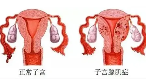 子宫腺肌症能去跟吗？有效的治疗方案大全