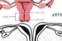 带你了解什么是纵膈子宫，别再和双子宫搞混了